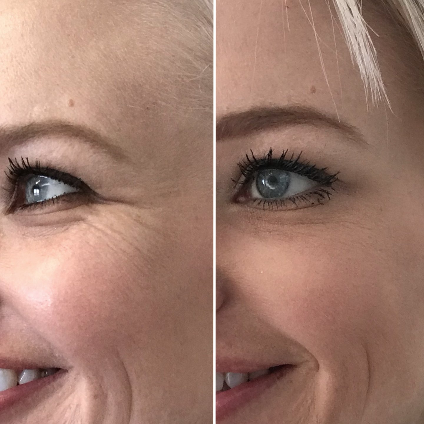 Botox - Crow's Feet