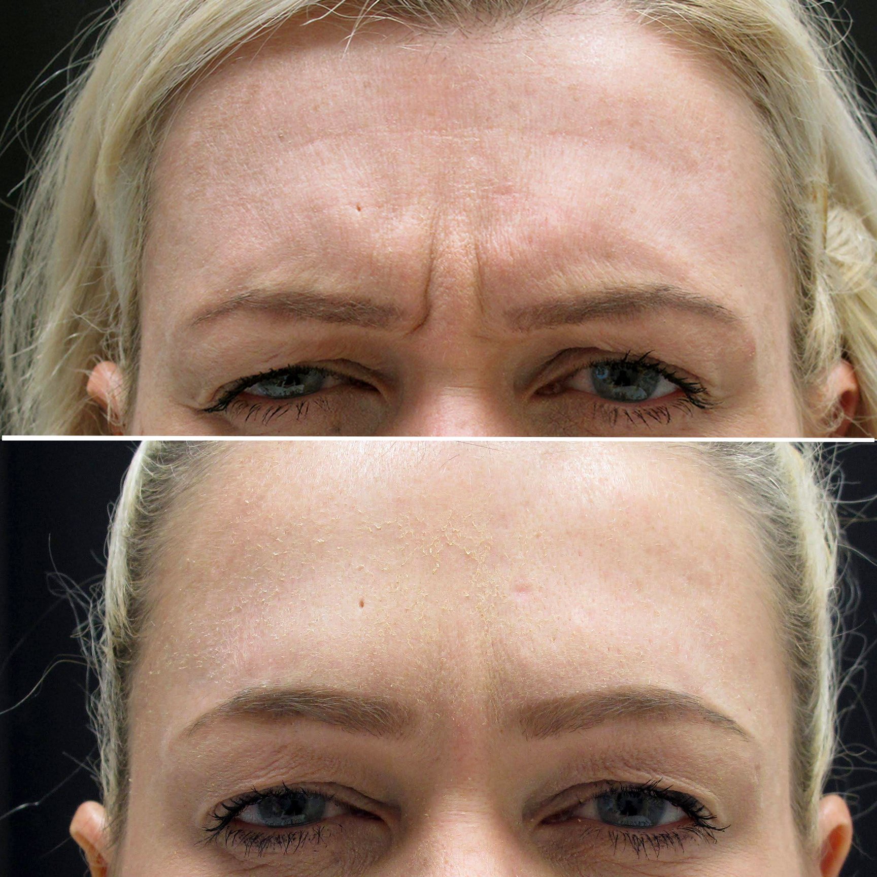 Botox - Forehead