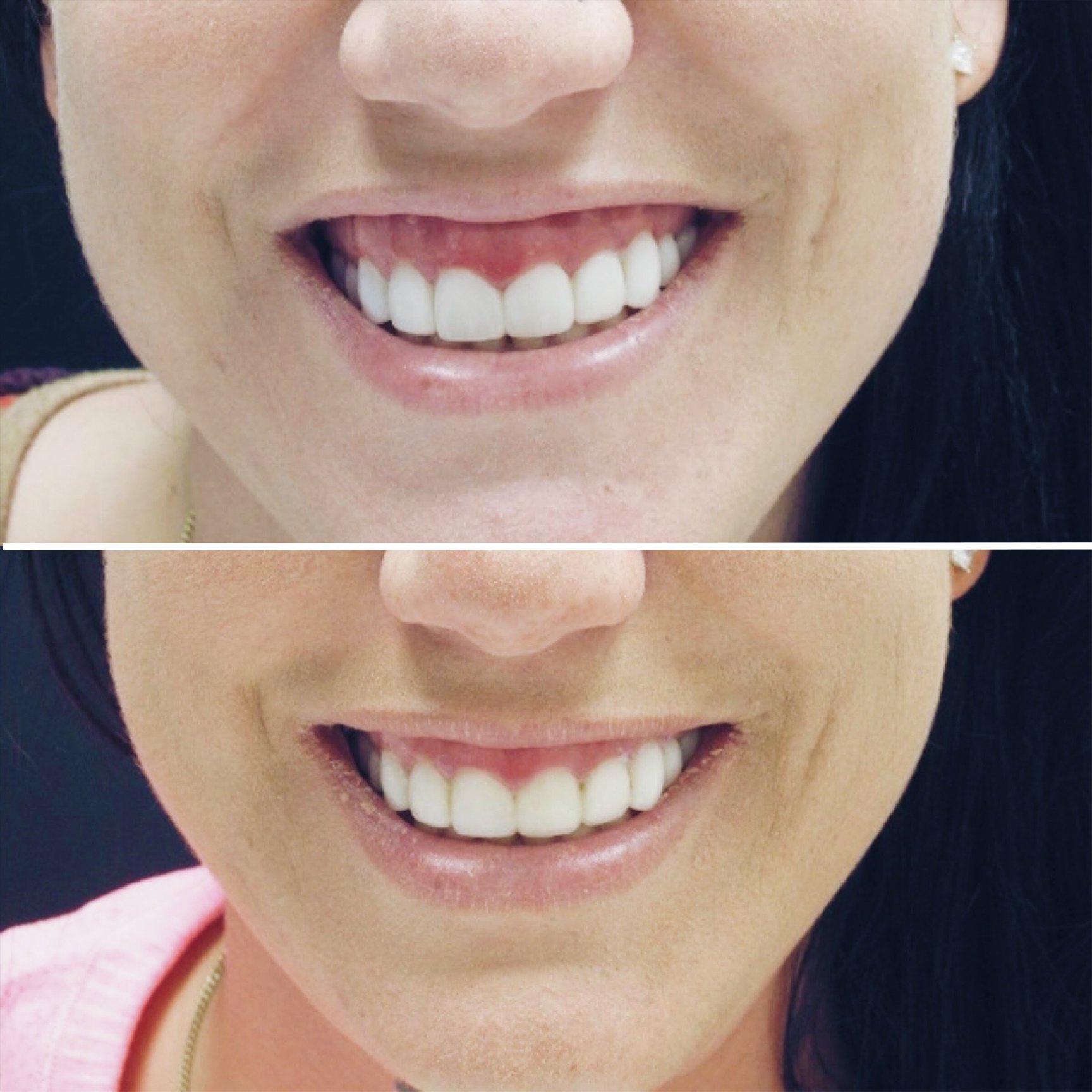 Botox - Gummy Smile
