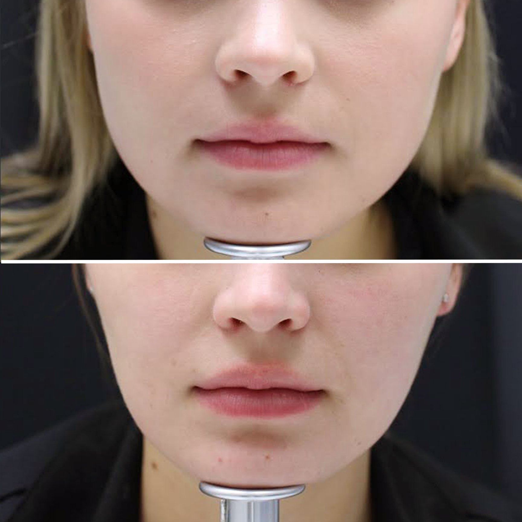 Botox - Masseter 