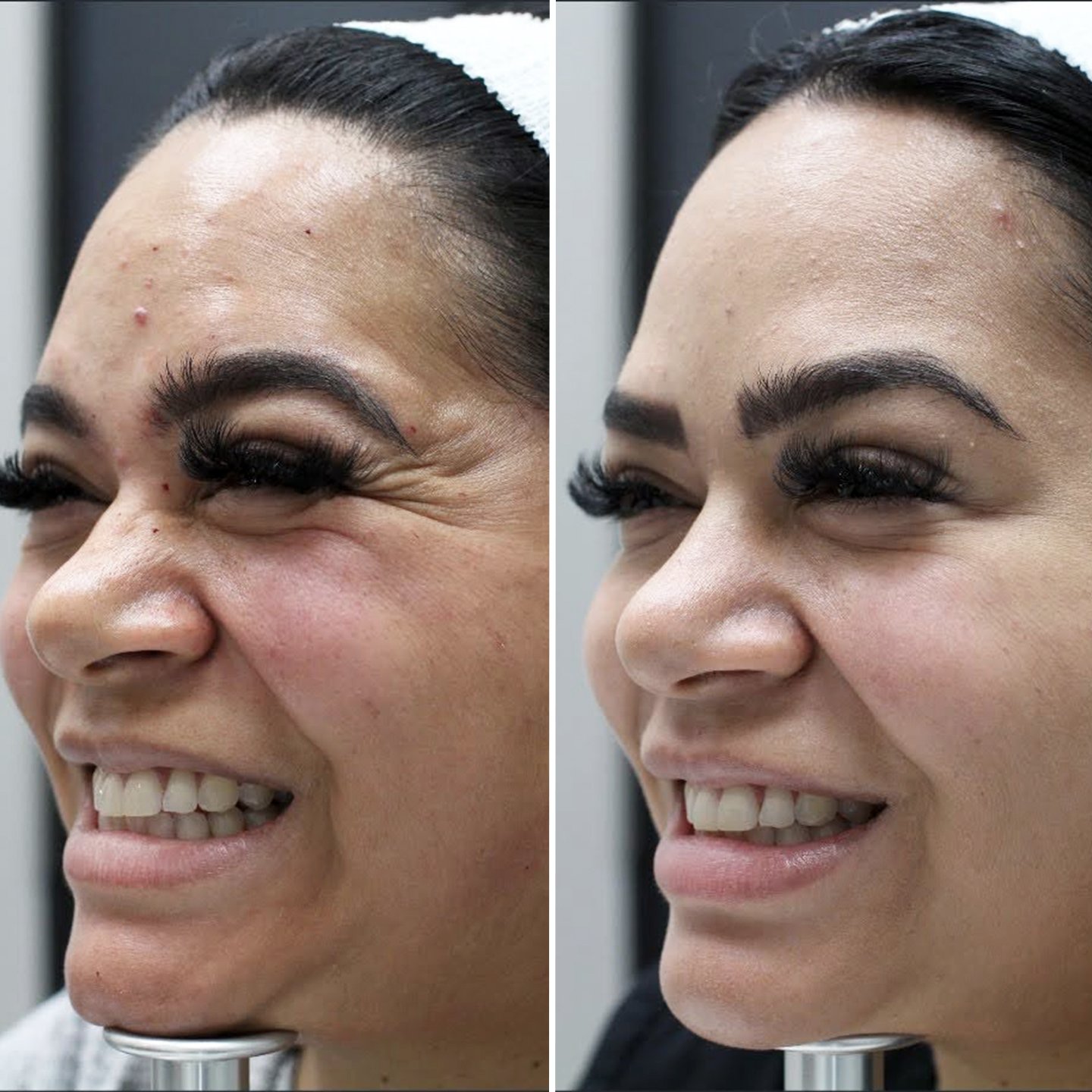 Botox - Crow's Feet