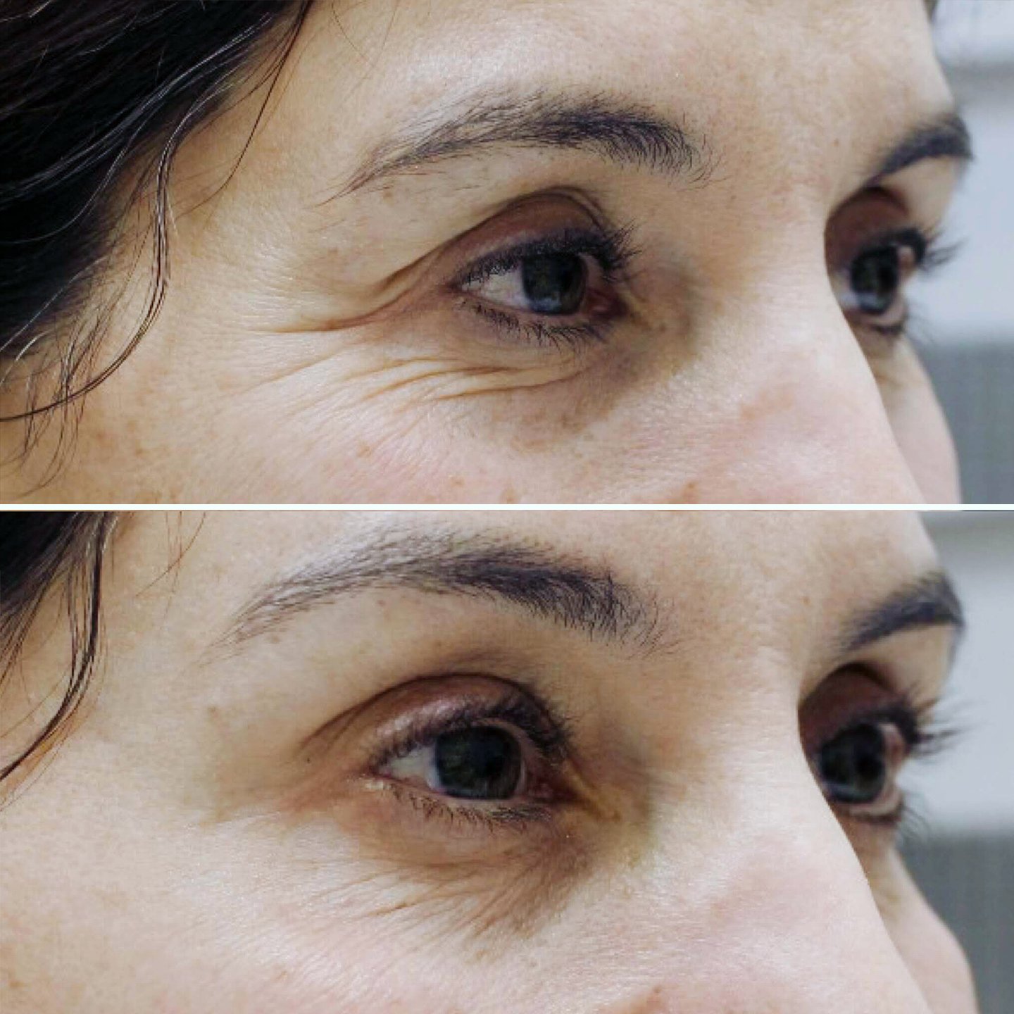 Botox - Crow's Feet